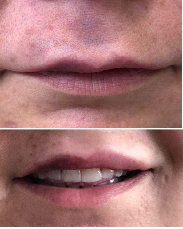 Fillers and Vessels The Story of Arterial Obstruction after Cosmetic